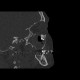 Follicular cyst of the maxillary sinus: CT - Computed tomography